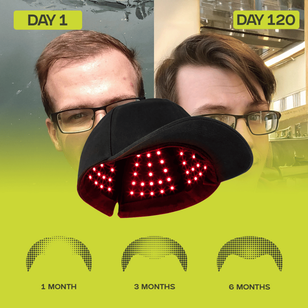 Laser Hair Regrowth Therapy Cap